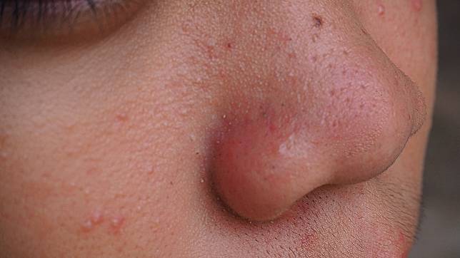 ▲鼻翼顆粒問題不解決，容易致粉刺痘痘與坑疤。  

