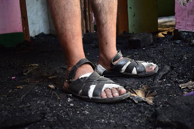 Mohammad Altaf Dar injured his feet escaping from his home after it caught fire. Photo: Sanna Irshad Mattoo