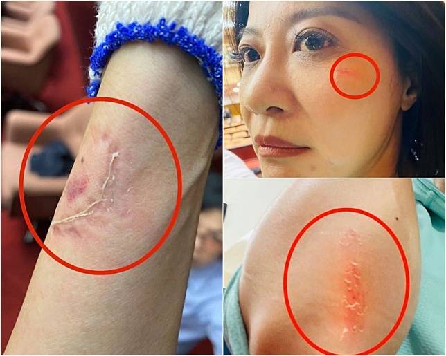 民進黨立委林楚茵在臉書上PO出傷口照片，指控她被國民黨立委呂玉玲咬傷，手臂還留下明顯的齒痕。(圖擷自林楚茵臉書)