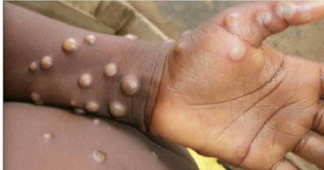 疾管署今（28）日公布國內6月計新增6例M痘（Mpox）本土確定病例，皆為本國籍男性。（示意圖／photoAC）