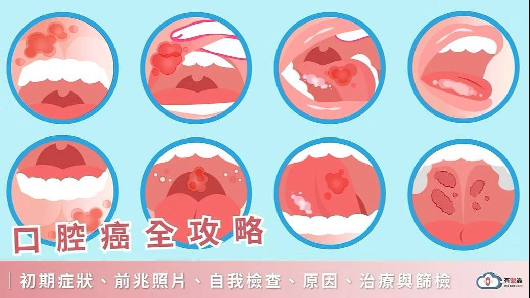 口腔癌最新治療方法有哪些？手術、放療、化療、免疫治療與存活率解析 | 有醫靠 | LINE TODAY