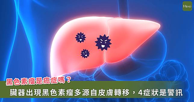 究竟什麼黑色素瘤？醫師解析症狀、原因及早期發現的關鍵