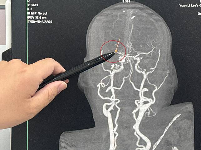 患者右腦梗塞性中風，造成左半身癱瘓。（圖／大甲李綜合醫院提供）