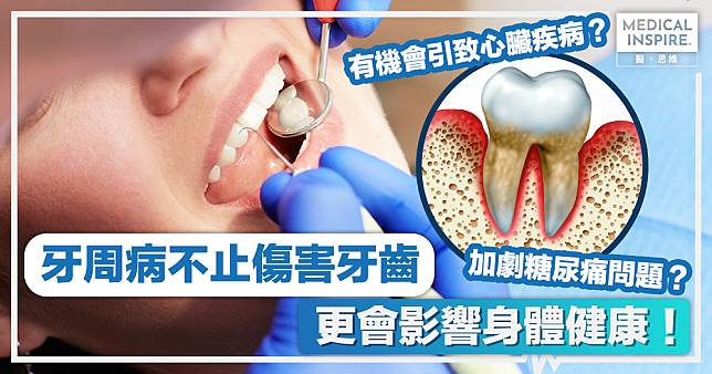 牙齒健康｜牙周病不止傷害牙齒、更會影響身體健康！