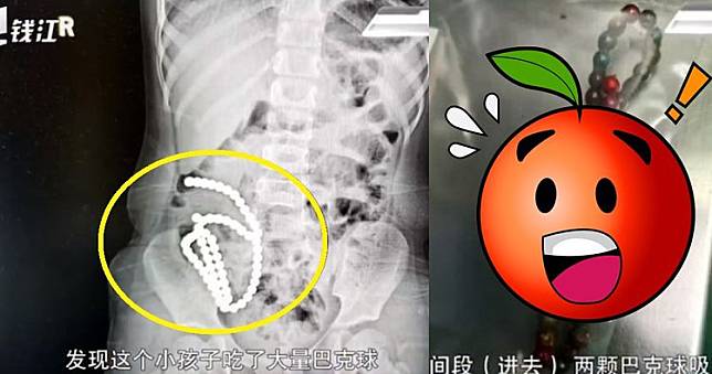 女童的腹部X光有約一公尺長的白點（左圖），手術後取出多達61顆俗稱「巴克球」的磁力珠（右圖）。翻攝微博/浙江大學醫學院附設兒童醫院