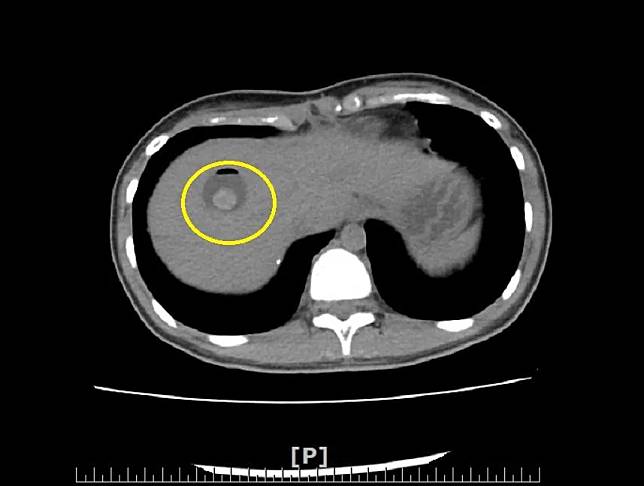 一名15歲女孩因罹患膽道囊腫（先天膽道異常）導致肝內膽道結石，造成膽管反覆發炎，出現腹痛、嘔吐等症狀，相當難受。（圖／南投醫院提供）