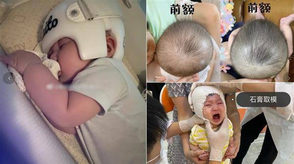 中國吹起矯正嬰兒頭型風潮，除了定型枕頭之外，矯正頭盔也是許多家長的選擇。非文中提及的雙胞胎。（圖片翻攝／微博_朝陽V姐的玫瑰花）
