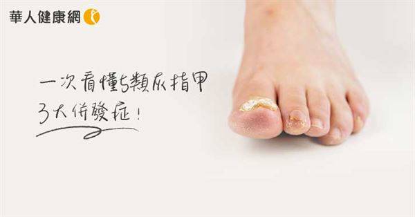 一次看懂5類灰指甲、3大併發症！慎防甲溝炎、蜂窩性組織炎，鞋子襪子聰明殺菌