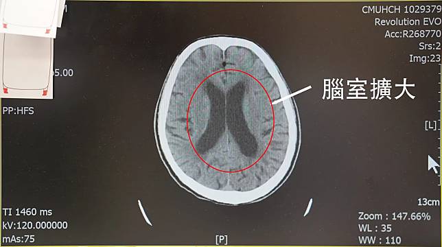 一名病患全身無力，走路不穩，檢查發現患者有腦室擴大及大腦脊髓液蓄積等狀況。（圖／中國醫藥大學新竹附設醫院）