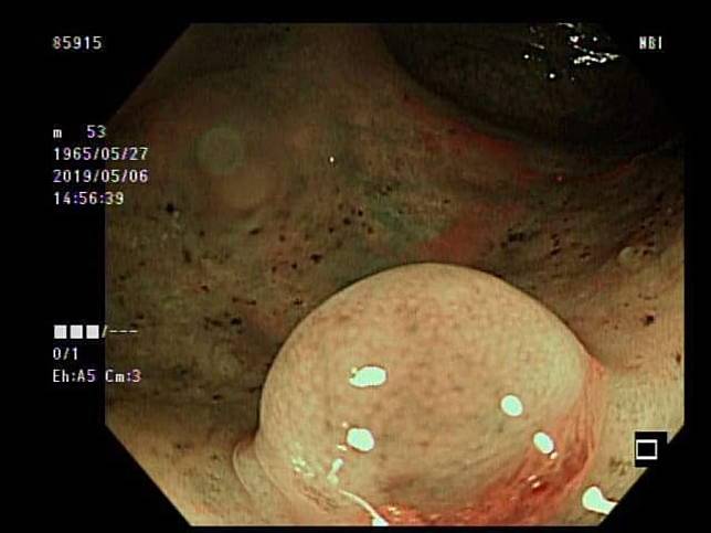 在直腸裡發現的「神經內分泌腫瘤」