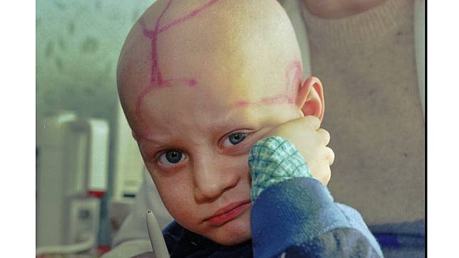 1996年3月19日，車諾比核電廠爆炸10年後，白俄羅斯一間醫院的兒童癌症病房，一名兒童頭上留有醫生化療後留下的標記。美聯社