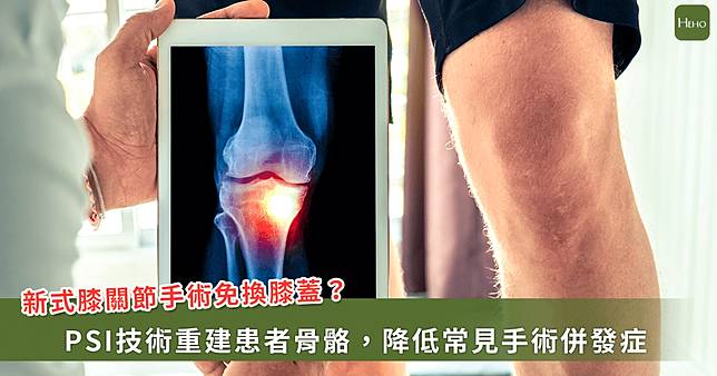 膝關節退化不必換膝？新術式「免換膝」，助患者找回行動力