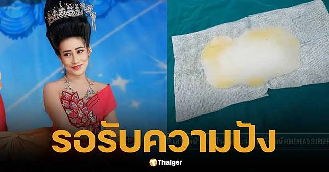 หนูรัตน์ ขึ้นเขียงถอดหน้าผาก ศัลกรรมอัปสวย ปิดตำนานปลาหมอสี