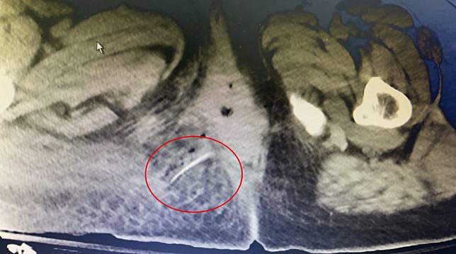 電腦斷層顯示魚刺的位置，橫叉右側臀部。（阮綜合醫院提供）