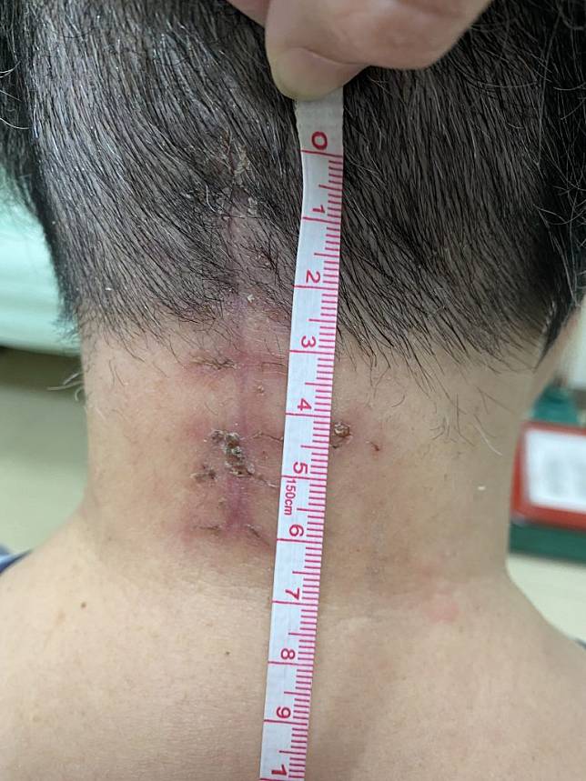 神經外科主任邵國寧發現患者，她的高位第二節頸椎斷裂，建議做頸椎內固定手術。（記者徐義雄攝）