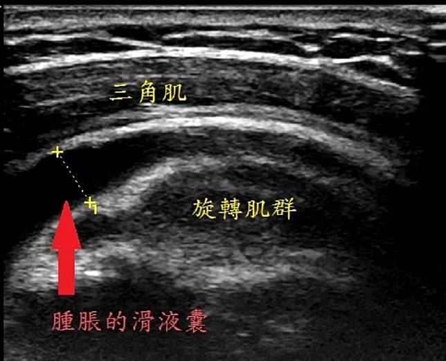 朴子醫院羅嘉元醫師說明患部疼痛是因三角肌下滑液囊炎引起。(圖／朴子醫院提供）