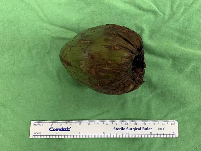 椰子大小長7.5公分、底部5.7公分。（圖／義大醫院提供）