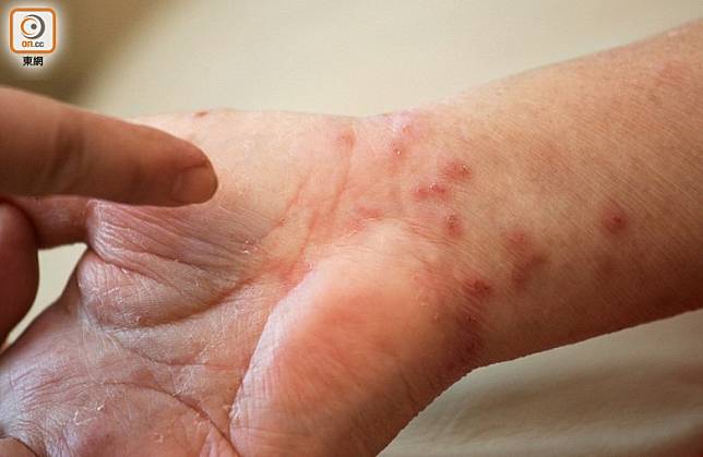 疥瘡患者會感到非常痕癢，皮膚表面可能出現紅疹或小水疱。