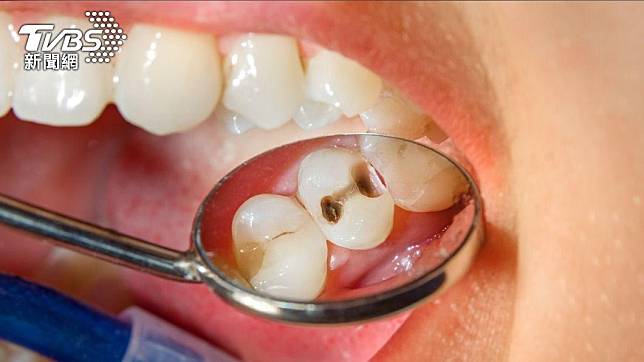 民眾天天用牙線還是蛀牙，對此感到困擾。（示意圖／shutterstock 達志影像）