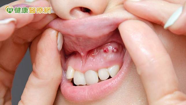 牙齦增生是指牙齒周圍的牙肉過度生長，除了常見因口腔衛生不良，造成慢性發炎的牙齦增生外，包含高血壓藥物、免疫抑制劑、抗癲癇藥物的長期使用，都有可能造成牙齦增生。