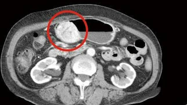 婦人胃腸道基質瘤已有6公分大小。國泰醫院提供