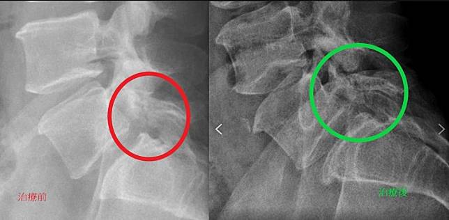 男子腰椎第五節椎弓骨折（圖左），以水介質震波讓骨折癒合（圖右），紓解下背痛，亦解決泌尿與消化系統難以啟齒的問題。　（記者王正平翻攝）