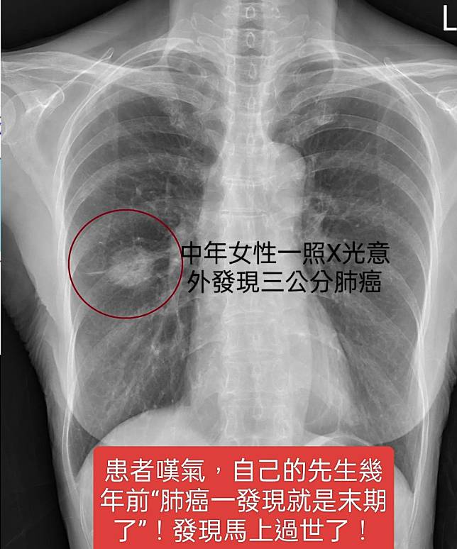 蘇一峰指出，有一對夫妻都罹患肺癌，原因是丈夫是重度吸菸者，且還常常在家中抽菸。（圖／翻攝自蘇一峰臉書）