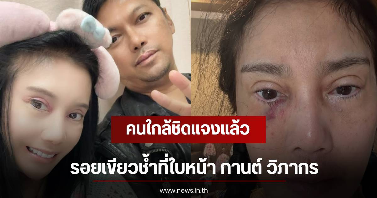 Close associate clarifies: Bruises on 'Karn Wiphakorn's' face caused by an accident