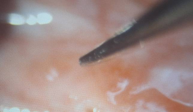 洪啟庭教授利用顯微鏡，以細針頭將明顯凸起的眼結石取出。（洪啟庭教授提供）