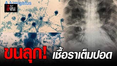 หนุ่มใหญ่ป่วยไข้หวัดใหญ่สายพันธ์ A พบเชื้อราลามเต็มปอด รักษา 30 วัน ก่อนสิ้นใจ