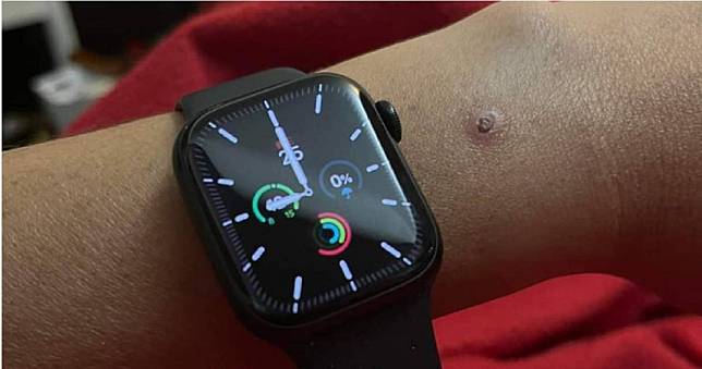 睡覺戴Apple watch被灼傷　他發文提醒直言：蘋果死不承認