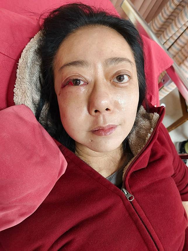 高慧君去年底暈倒臉部3處骨折。經紀人提供