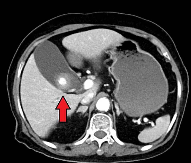 43歲婦人莫名出現上腹悶痛、噁心想吐症狀，就醫檢查才發現「膽囊裡有結石」，且合併膽囊炎。電腦斷層顯示碩大的膽結石（箭頭所示）。（圖／奇美醫院提供，下同）