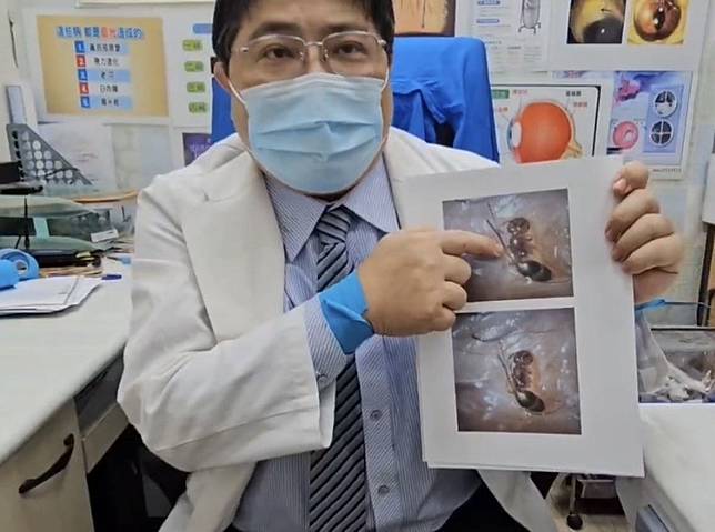 洪啟庭醫師說明小螞蟻爬進男童眼睛的情形。（圖：洪啟庭醫師提供）