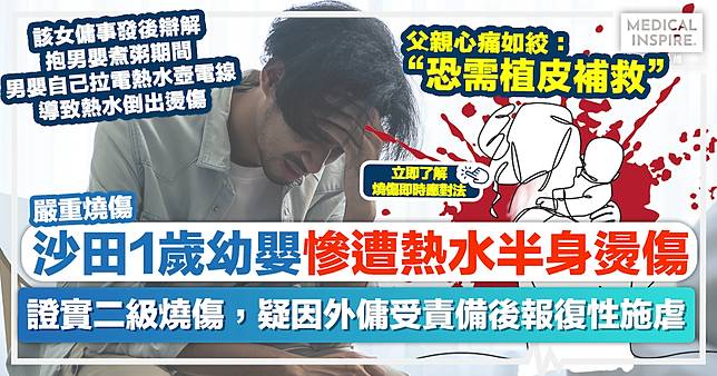 嚴重燒傷｜沙田1歲幼嬰慘遭熱水半身燙傷！疑因外傭受責備後報復性施虐？父親心痛如絞：恐需植皮補救