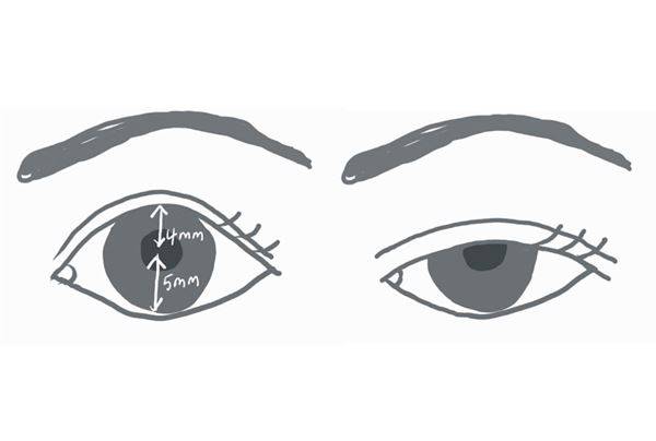 正常眼睛的黑眼珠可露出8-9釐米，一旦眼瞼垂到瞳孔，不僅看起來沒有精神，還會遮蔽視線。（圖片／亞東醫院提供）