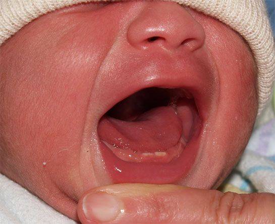 ฟันแถม ฟันที่ทารกแรกเกิดมีงอกออกมา