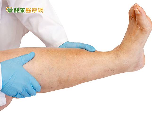 醫師提醒，深層靜脈栓塞可能引起靜脈曲張，因此進行相關檢查時，要多留意深層靜脈栓塞病灶。