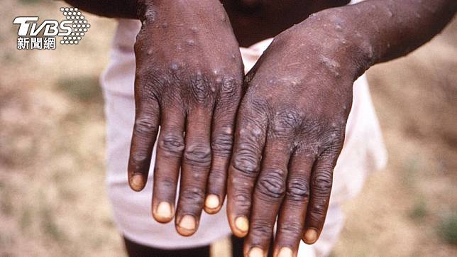 研究人員在剛果發現居民感染猴痘的症狀。（圖/達志影像美聯社）