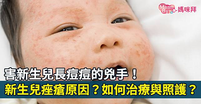 害新生兒長痘痘的兇手！新生兒痤瘡原因？如何治療與照護？