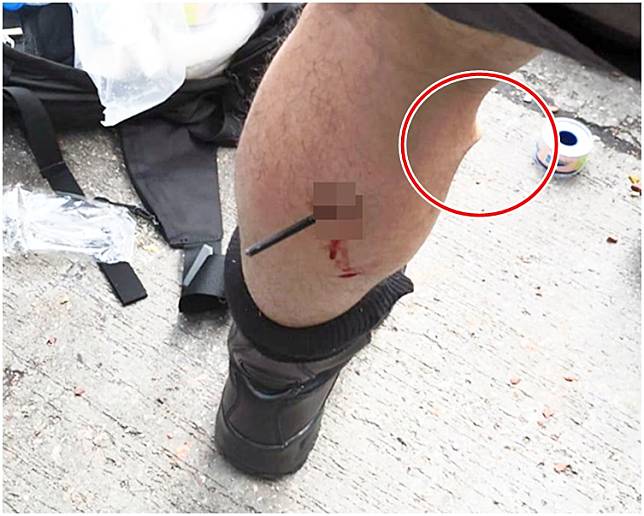 警員被弓箭射中左小腿，金屬箭頭從小腿背後插入，幾乎貫穿（紅圈示）。