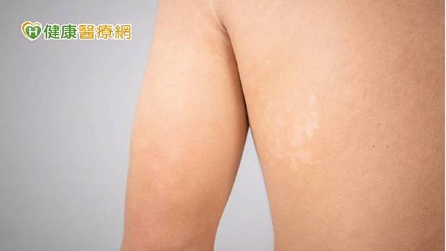 汗斑較少因為直接接觸而傳染，但如果皮膚處於常流汗、較悶熱的情況下，就有被他人傳染的可能。