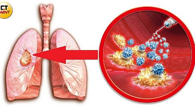 肺癌死亡率連續蟬連10年冠軍，是最致命的癌症。圖／CTWANT授權使用