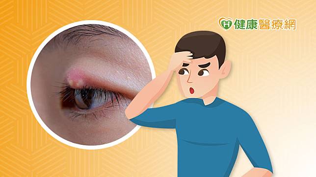 長針眼開始時可能只覺得眼瞼有點不適，如果沒有及時就醫，可能會局部紅腫、充血，有壓痛或脹痛的感受。