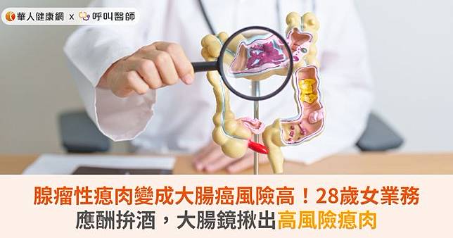 腺瘤性瘜肉變成大腸癌風險高！28歲女業務應酬拚酒，大腸鏡揪出高風險瘜肉
