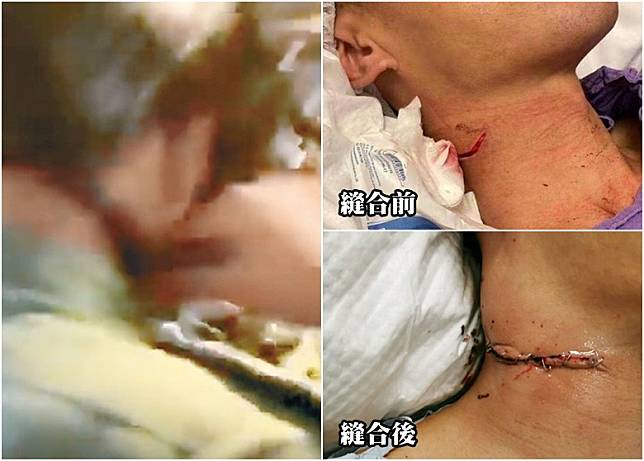 該名頸傷警員接受治療後、頸部傷勢獲縫合之後的相片曝光。