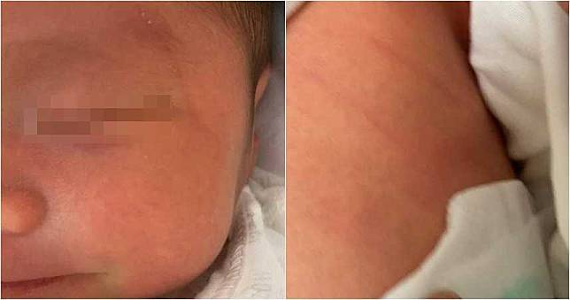 獨家／16歲小媽媽喜獲麟兒　3天後男嬰臉上背部出現不明傷痕