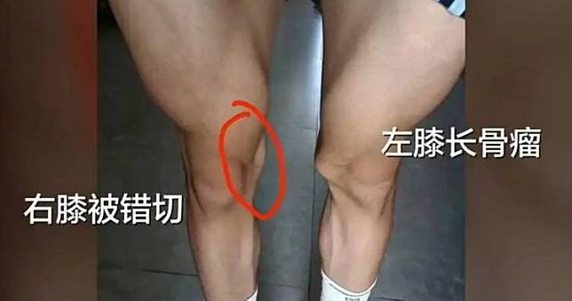 17歲體育生左膝長骨瘤！醫生竟「錯切右膝」　母親發聲：不接受和解