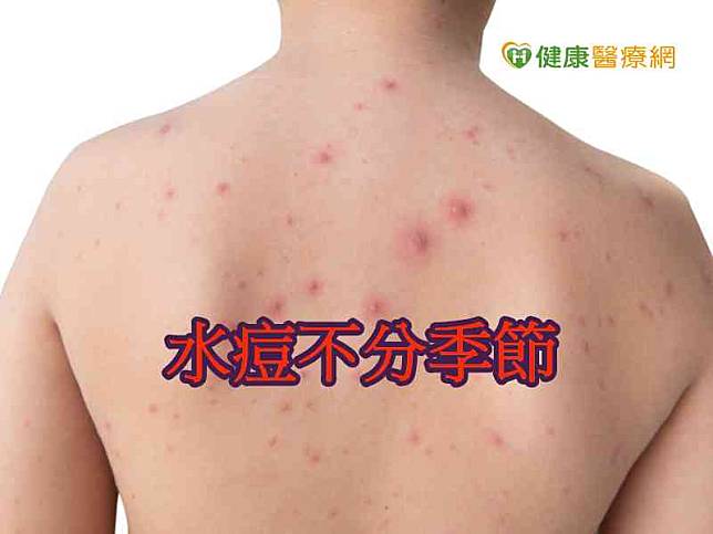 吳俞哖醫師呼籲，水痘主要由空氣、飛沫傳染與皮疹接觸傳染，因此隔離是避免感染很重要的方法。