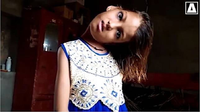 巴基斯坦一名11歲的女童，整個頸部呈現90度扭曲。(圖／翻攝自YouTube)